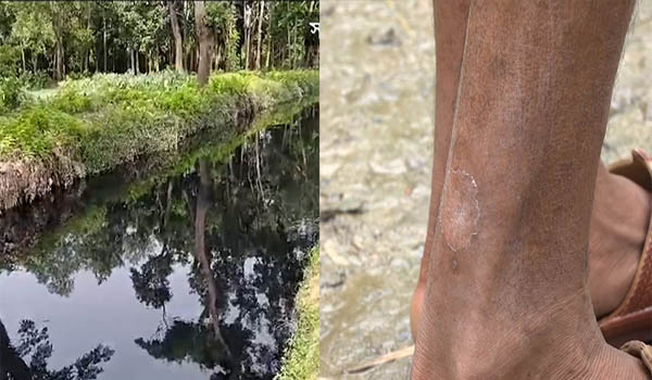 ভারত থেকে ভেসে আসা বর্জ্যে ব্রাহ্মণবাড়িয়ায় বাড়ছে পানিবাহিত রোগ