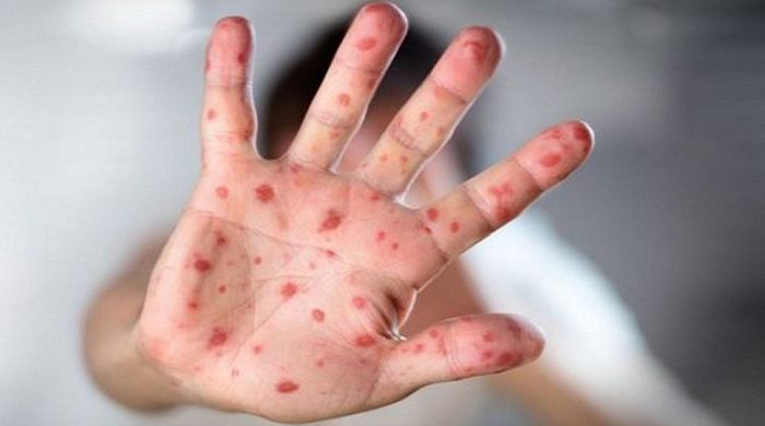 হাম ও হামের উপসর্গে আরও ৭ জনের মৃত্যু