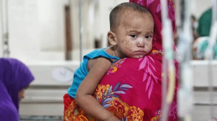 হাম উপসর্গে আরও ৩ শিশুর মৃত্যু, আক্রান্ত ৭৮৬ জন