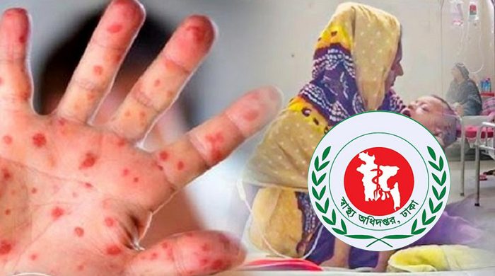 হাম-উপসর্গে আরও ৫ শিশুর মৃত্যু, নতুন আক্রান্ত ১০২৫